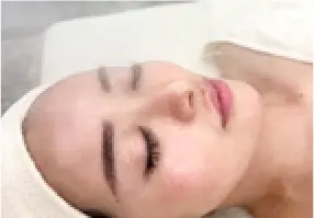 女性が顔に水玉リフティングを施術している画像